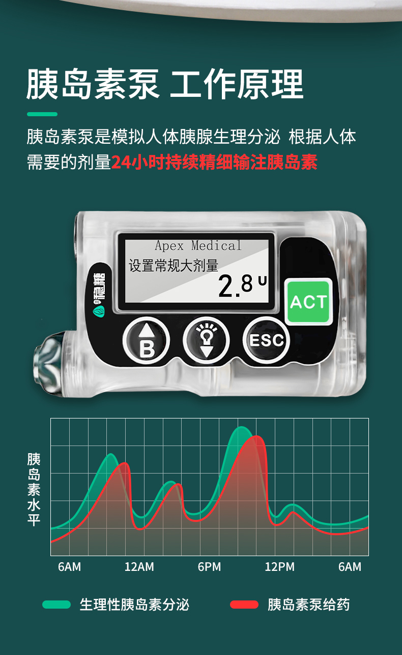 最新全自動胰島素泵，糖尿病管理的革命性進步，全自動胰島素泵，糖尿病管理的突破性革新