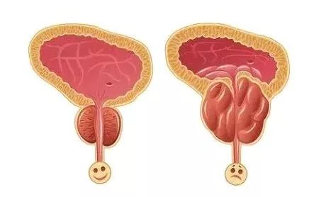 老公的前列腺增大挑戰(zhàn)，理解、支持與共同對抗，老公前列腺增大，理解、支持與共同應對的挑戰(zhàn)