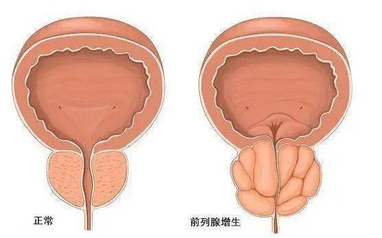 前列腺鈣化，一種常見的前列腺疾病及其相關(guān)知識(shí)解析，前列腺鈣化解析，常見疾病與相關(guān)知識(shí)探討