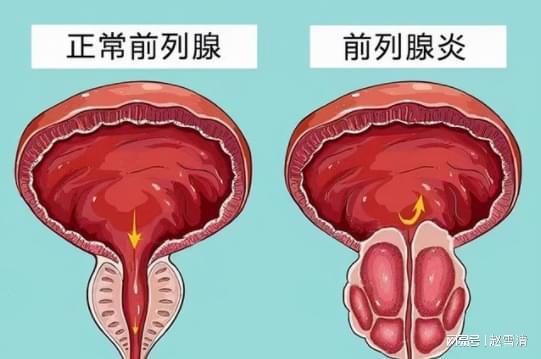 男性前列腺炎的癥狀解析，男性前列腺炎的癥狀詳解