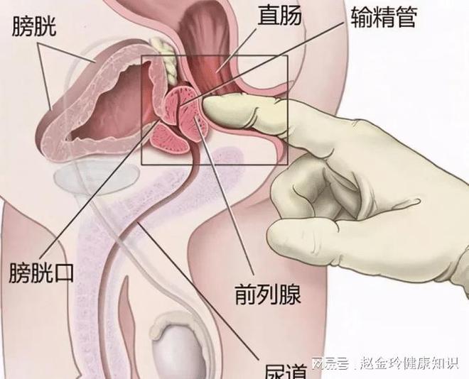 慢性前列腺炎，能否徹底治愈？解析與探討，慢性前列腺炎的治愈可能性解析與探討