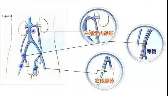 右邊睪丸隱痛會自愈嗎？解析原因與應(yīng)對之道，右邊睪丸隱痛，原因解析與自愈可能性探討