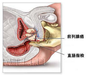 根治前列腺疾病的最佳中藥偏方，探尋古老智慧的新希望，古老智慧新希望，最佳中藥偏方根治前列腺疾病