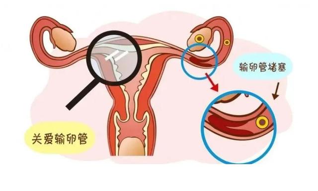 輸卵管堵塞的癥狀表現(xiàn)與解析，輸卵管堵塞的癥狀、表現(xiàn)與解析