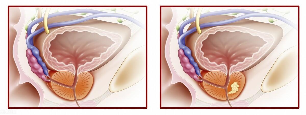前列腺鈣化，揭示其潛在危害，前列腺鈣化，潛在危害揭秘