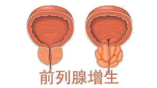 前列腺增生藥物治療效果評估與最佳用藥選擇，前列腺增生藥物治療效果評估及最佳用藥選擇探討